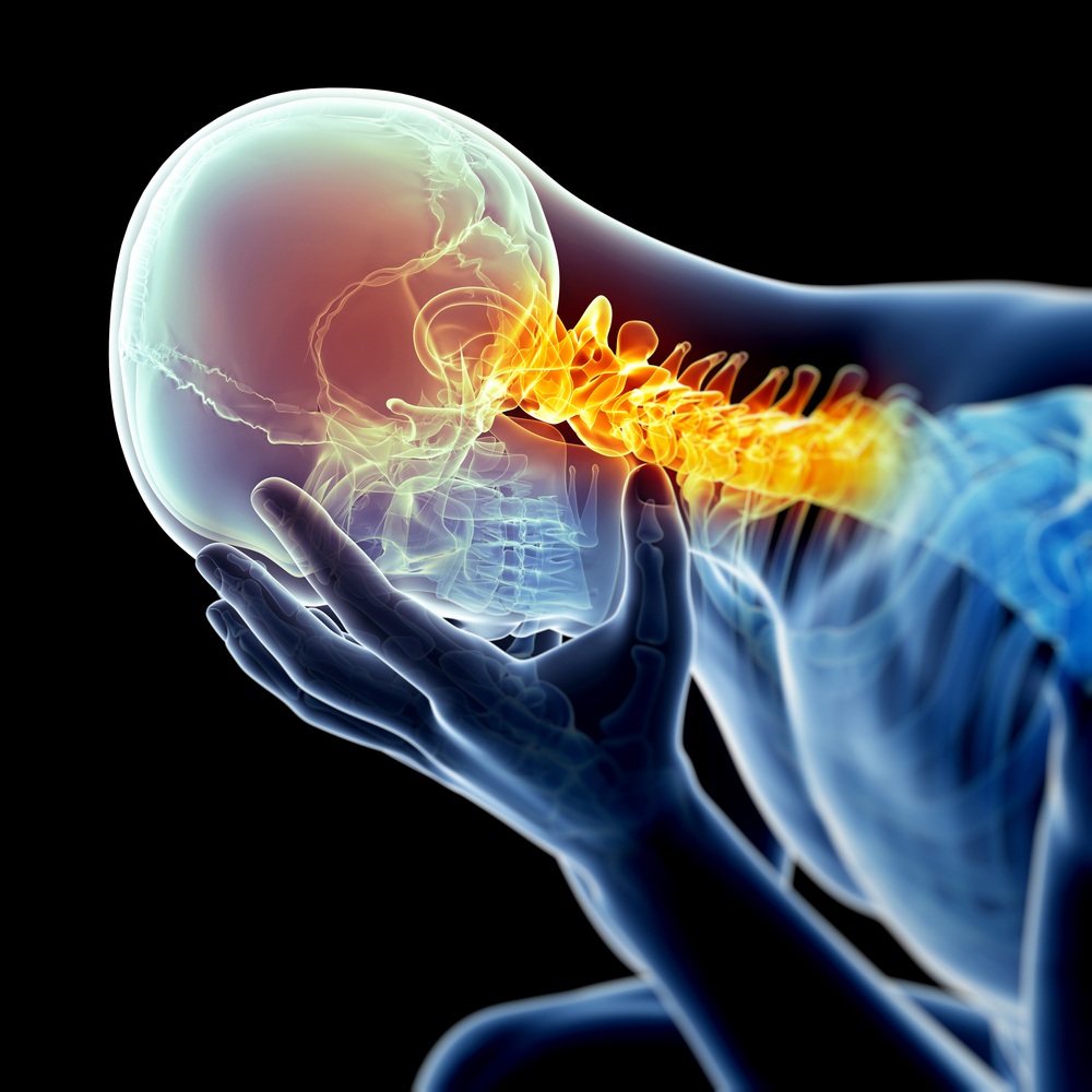 Neck pain image as a trigger for migraine.